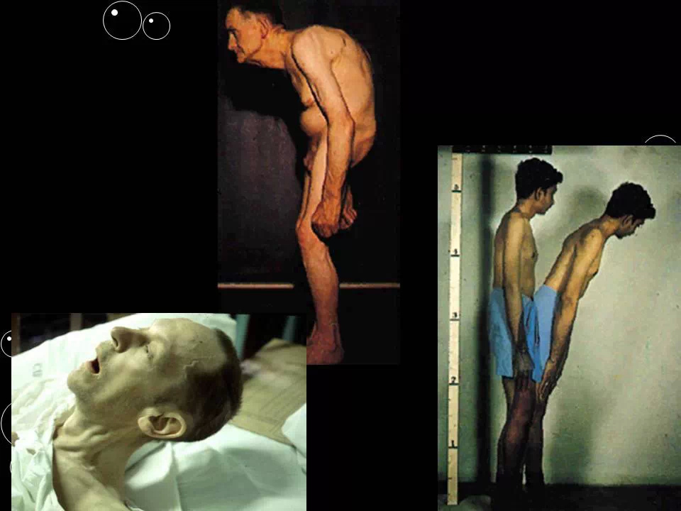 南京强脊诊疗中心强直性脊柱炎研究院