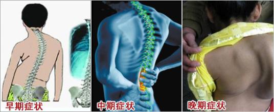 南京强脊诊疗中心强直性脊柱炎研究院