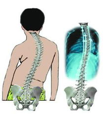 南京强脊诊疗中心强直性脊柱炎研究院